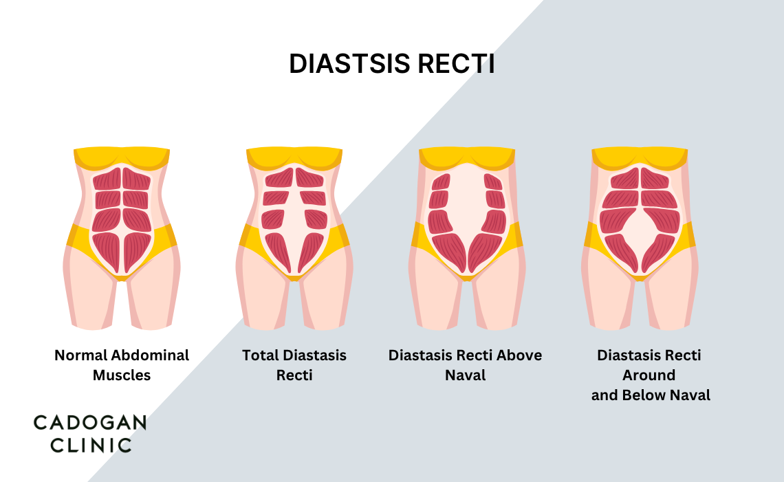 An infographic showing the placement of abdominal muscle separation in different types of Diastasis Recti